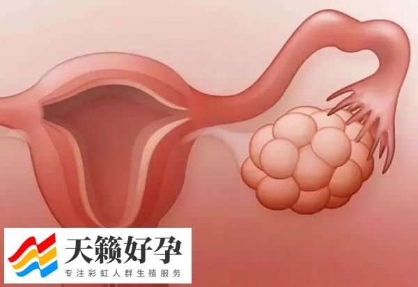 多囊导致排卵障碍不孕，这3大症状可判断(图2)